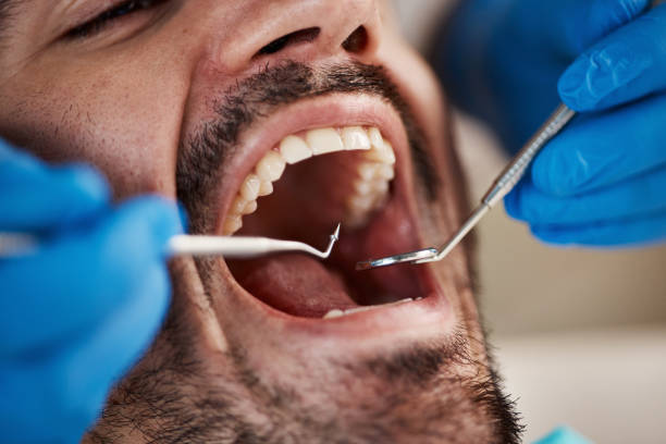Best Knocked-Out Tooth (Avulsed Tooth) Treatment in Holiday City South, NJ